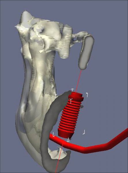 Cone Beam<br/><br/> Simulation tridimensionnelle pré-implantaire réalisée à partir du CD-ROM fourni contenant les coupes axiales au format DICOM.